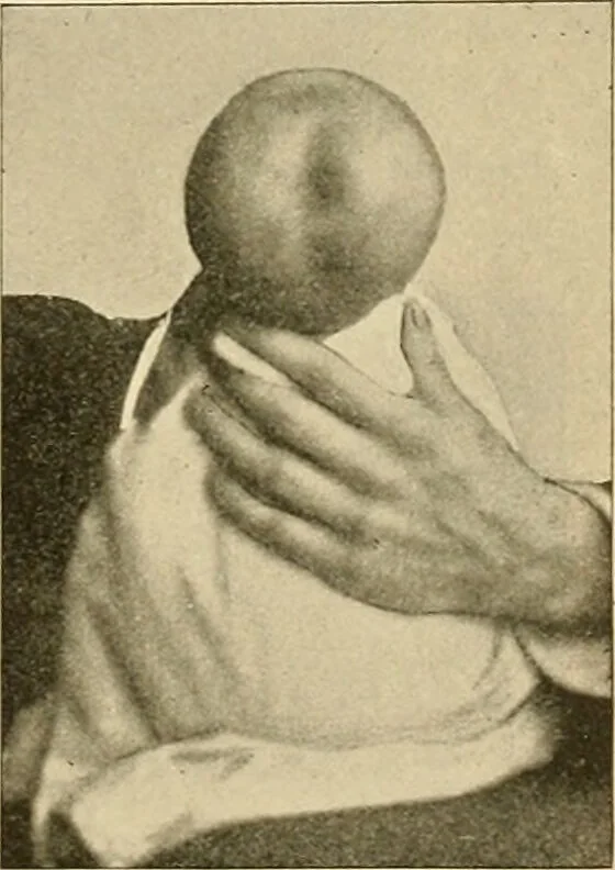 An illustration from Pediatrics : the hygienic and medical treatment of children / by Thomas Morgan Rotch., 1898, leaf 447
