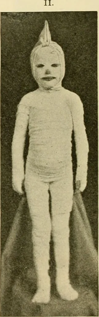 An illustration from Pediatrics : the hygienic and medical treatment of children / by Thomas Morgan Rotch., 1898, leaf 520