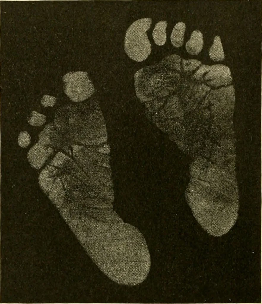 An illustration from Pediatrics : the hygienic and medical treatment of children / by Thomas Morgan Rotch., 1898, leaf 60