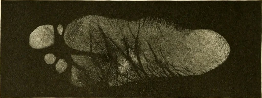 An illustration from Pediatrics : the hygienic and medical treatment of children / by Thomas Morgan Rotch., 1898, leaf 60