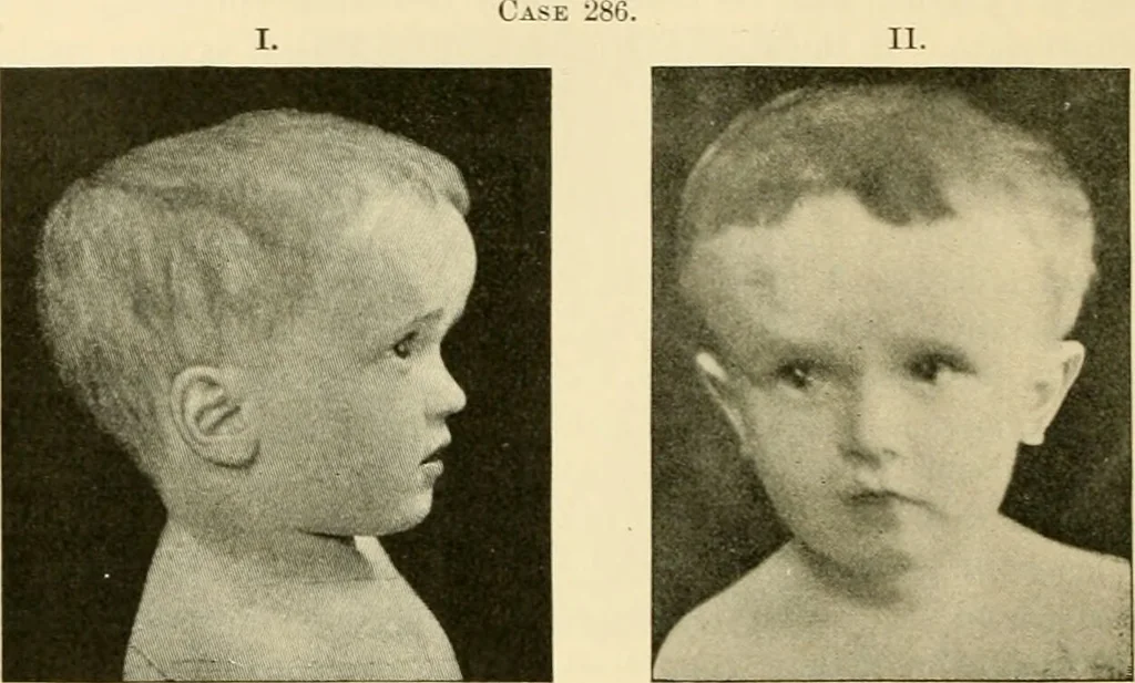 An illustration from Pediatrics : the hygienic and medical treatment of children / by Thomas Morgan Rotch., 1898, leaf 694