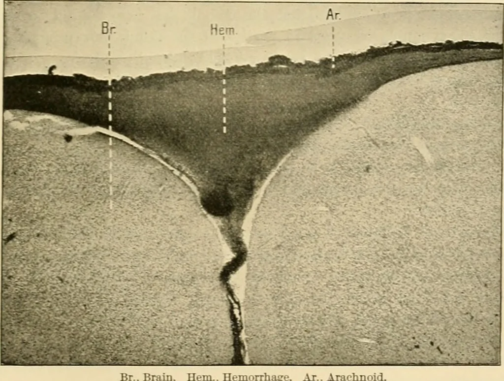 An illustration from Pediatrics : the hygienic and medical treatment of children / by Thomas Morgan Rotch., 1898, leaf 707