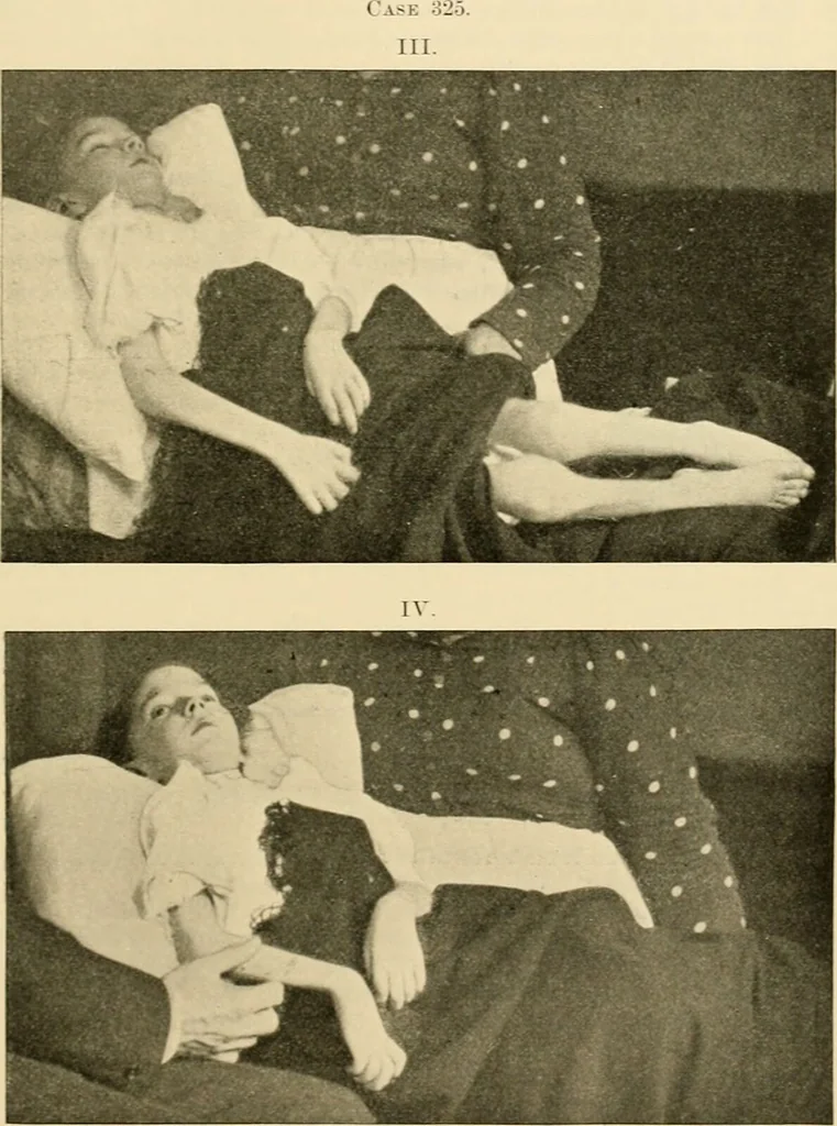An illustration from Pediatrics : the hygienic and medical treatment of children / by Thomas Morgan Rotch., 1898, leaf 759