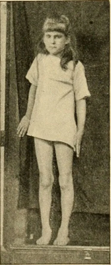 An illustration from Pediatrics : the hygienic and medical treatment of children / by Thomas Morgan Rotch., 1898, leaf 763
