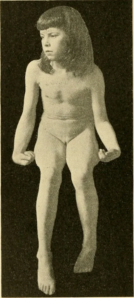 An illustration from Pediatrics : the hygienic and medical treatment of children / by Thomas Morgan Rotch., 1898, leaf 774
