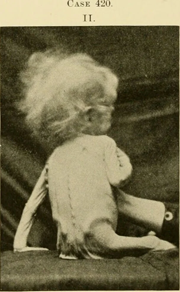 An illustration from Pediatrics : the hygienic and medical treatment of children / by Thomas Morgan Rotch., 1898, leaf 938