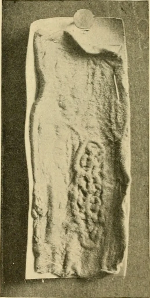 An illustration from Pediatrics : the hygienic and medical treatment of children / by Thomas Morgan Rotch., 1898, leaf 956