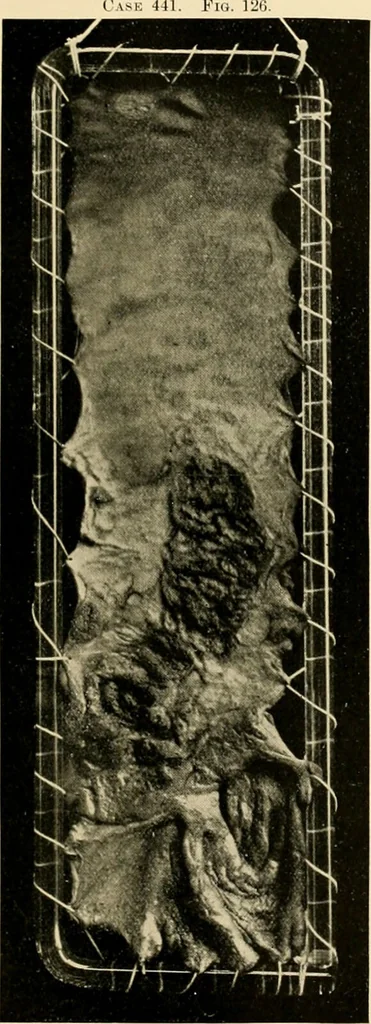 An illustration from Pediatrics : the hygienic and medical treatment of children / by Thomas Morgan Rotch., 1898, leaf 979