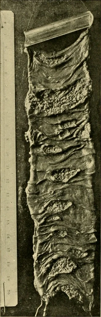 An illustration from Pediatrics : the hygienic and medical treatment of children / by Thomas Morgan Rotch., 1898, leaf 984