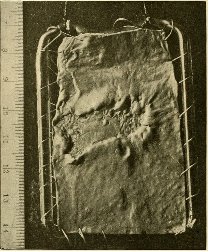 An illustration from Pediatrics : the hygienic and medical treatment of children / by Thomas Morgan Rotch., 1898, leaf 986