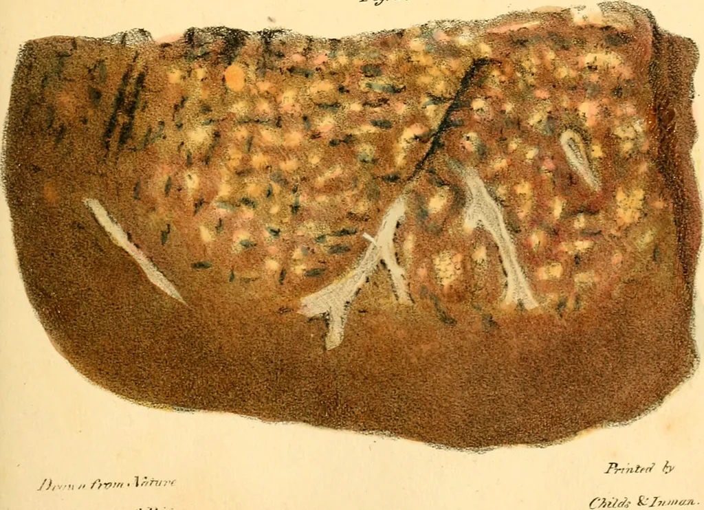 An illustration from Illustrations of pulmonary consumption : its anatomical characters, causes, symptoms and treatment. With twelve plates, drawn and coloured from nature / By Samuel George Morton., 1834, leaf 193