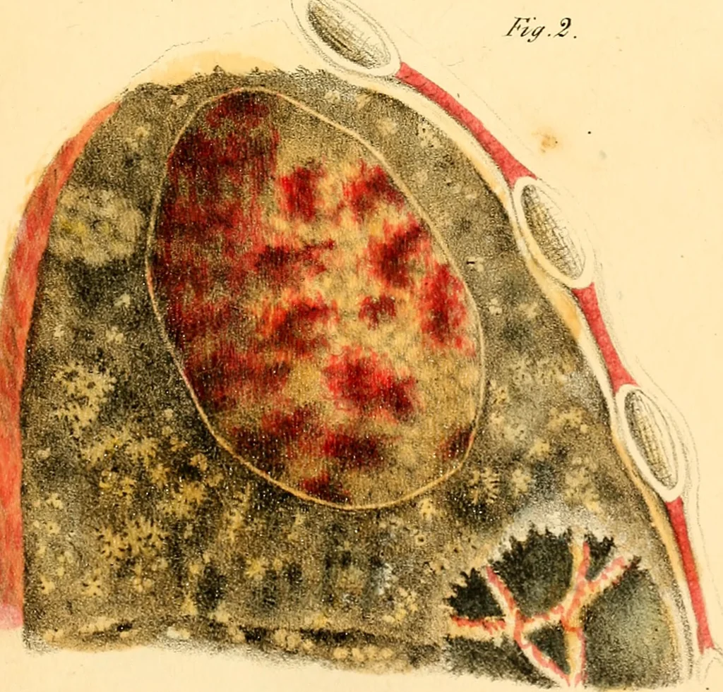An illustration from Illustrations of pulmonary consumption : its anatomical characters, causes, symptoms and treatment. With twelve plates, drawn and coloured from nature / By Samuel George Morton., 1834, leaf 197