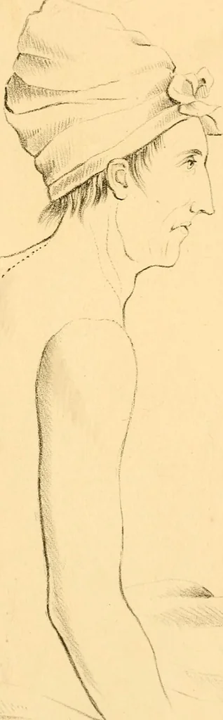 An illustration from Illustrations of pulmonary consumption : its anatomical characters, causes, symptoms and treatment. With twelve plates, drawn and coloured from nature / By Samuel George Morton., 1834, leaf 203