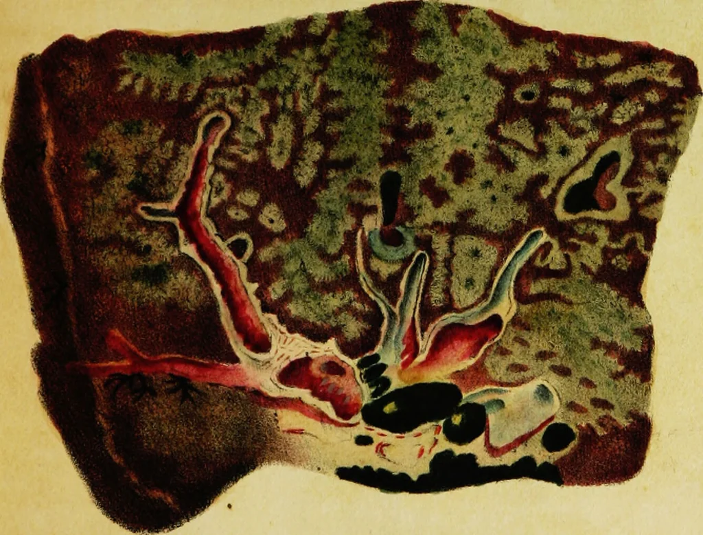 An illustration from Illustrations of pulmonary consumption : its anatomical characters, causes, symptoms and treatment. With twelve plates, drawn and coloured from nature / By Samuel George Morton., 1834, leaf 191