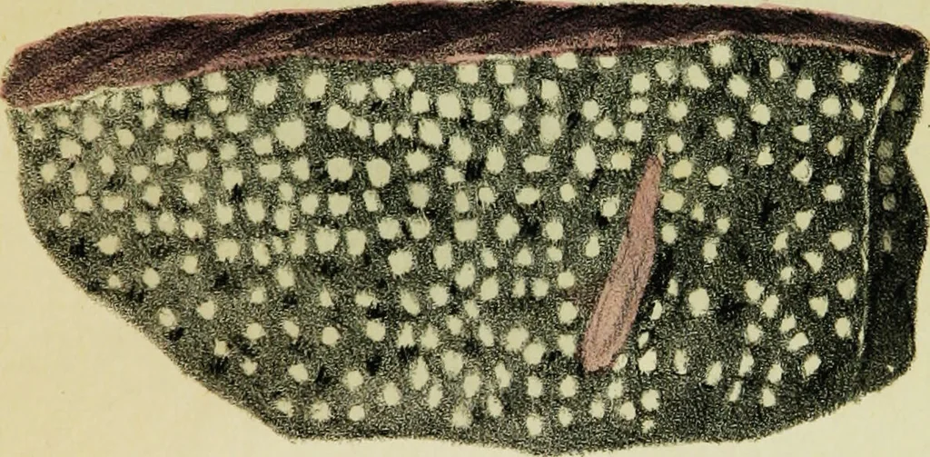 An illustration from Illustrations of pulmonary consumption : its anatomical characters, causes, symptoms and treatment. With twelve plates, drawn and coloured from nature / By Samuel George Morton., 1834, leaf 193