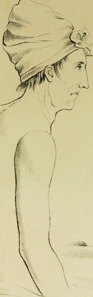 An illustration from Illustrations of pulmonary consumption : its anatomical characters, causes, symptoms and treatment. With twelve plates, drawn and coloured from nature / By Samuel George Morton., 1834, leaf 205