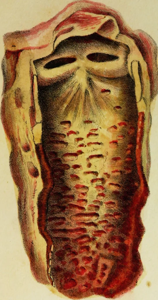 An illustration from Illustrations of pulmonary consumption : its anatomical characters, causes, symptoms and treatment. With twelve plates, drawn and coloured from nature / By Samuel George Morton., 1834, leaf 209