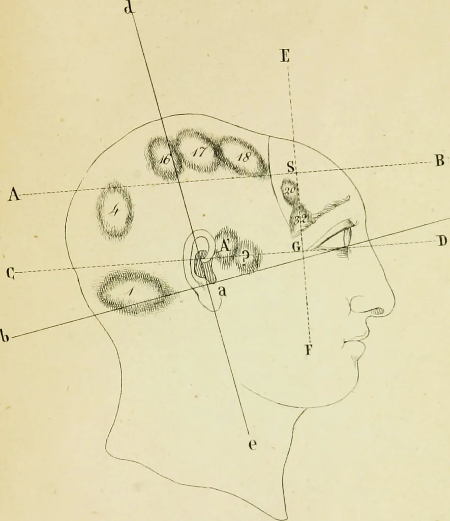 An illustration from Cenno su di una nuova classificazione e di una nuova statistica delle alienazioni mentali, fondate su principì frenologici considerati nei loro rapporti con la patologia del cervello, del Biagio G. Miraglia., 1847, leaf 93