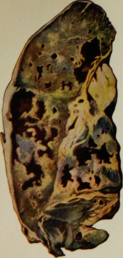 An illustration from Tuberculosis and allied diseases : an account of their origin and treatment from the earliest times up to and including the present / by Freeman Hall .., 1912, leaf 173