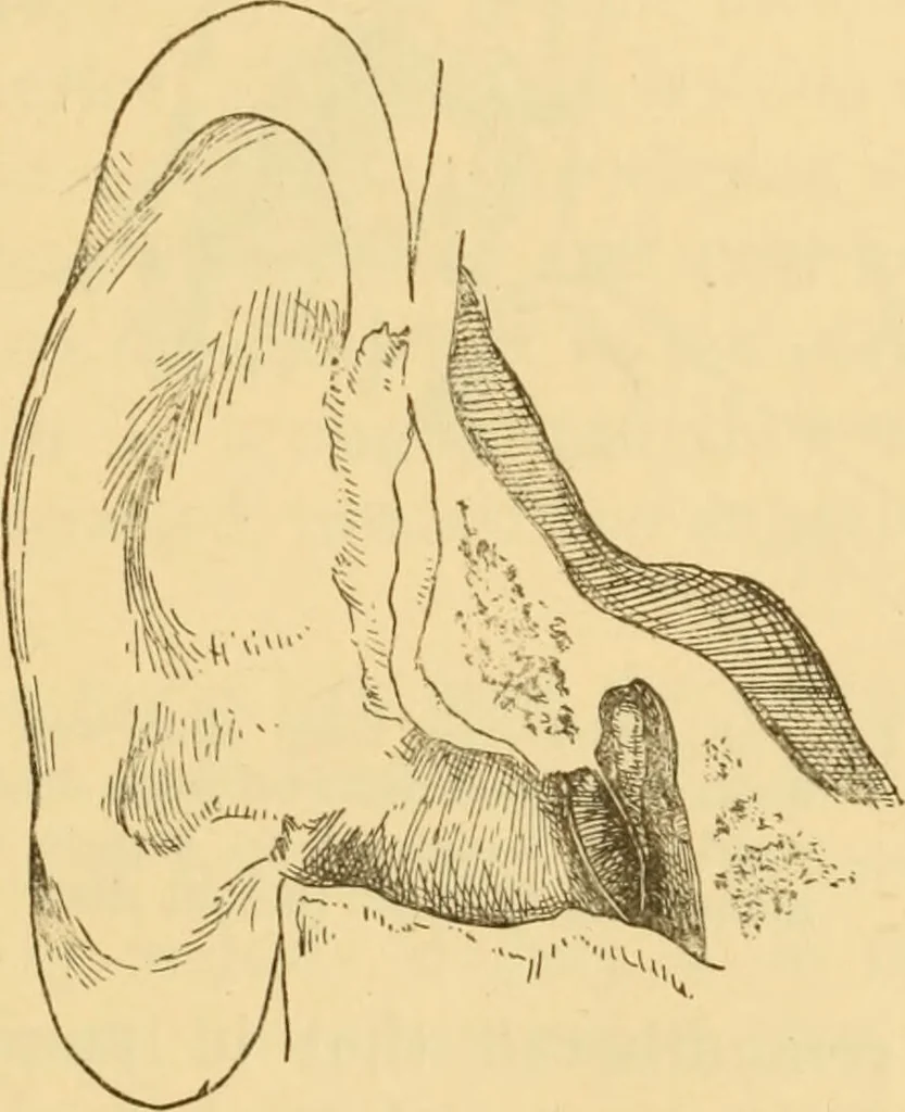 An illustration from Diseases of the ear : a text-book for practitioners and students of medicine / by Edward Bradford Dench., 1900, leaf 111