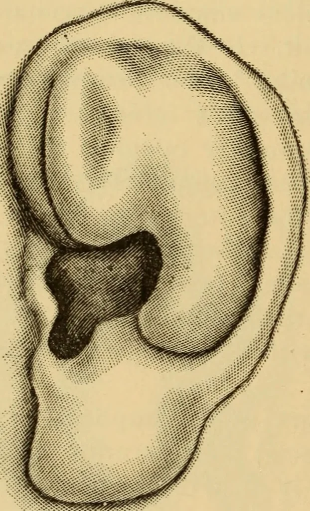 An illustration from Diseases of the ear : a text-book for practitioners and students of medicine / by Edward Bradford Dench., 1900, leaf 240