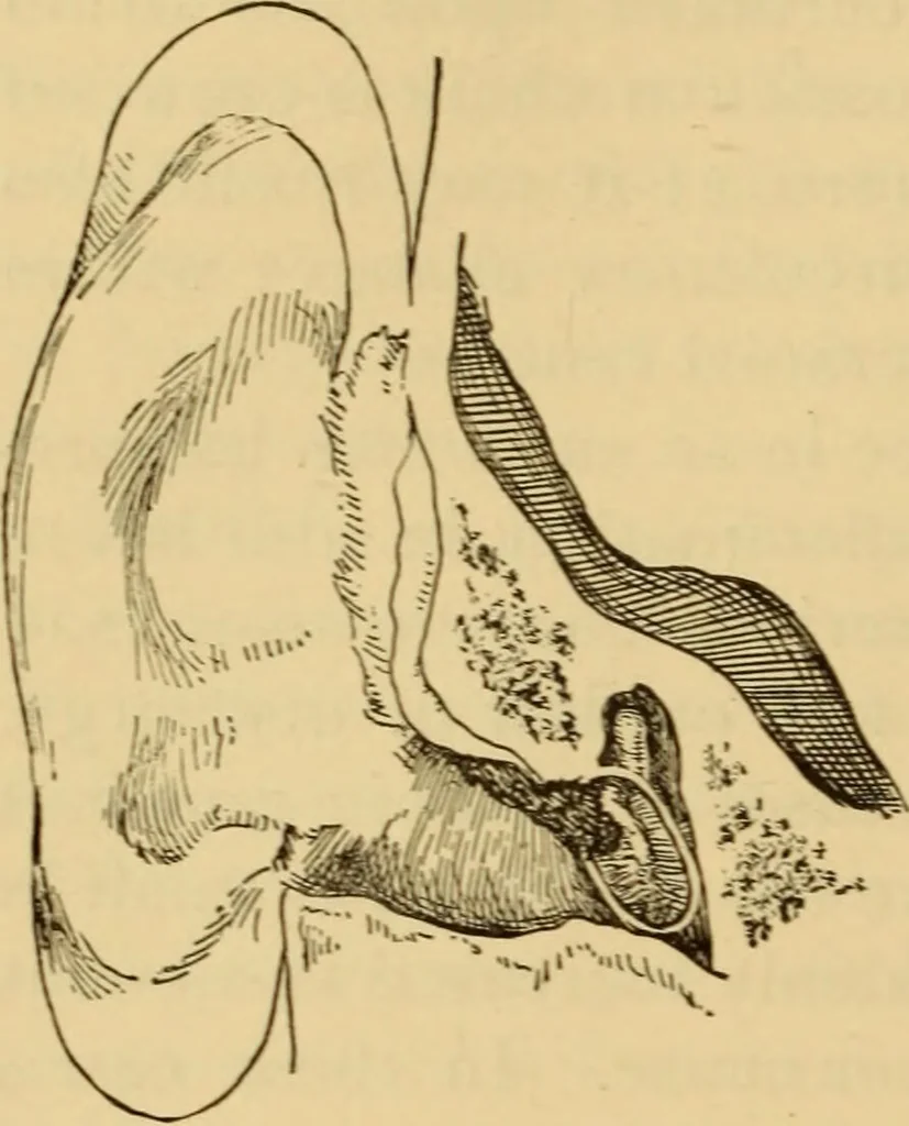 An illustration from Diseases of the ear : a text-book for practitioners and students of medicine / by Edward Bradford Dench., 1900, leaf 310