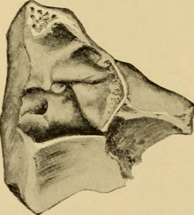 An illustration from Diseases of the ear : a text-book for practitioners and students of medicine / by Edward Bradford Dench., 1900, leaf 42