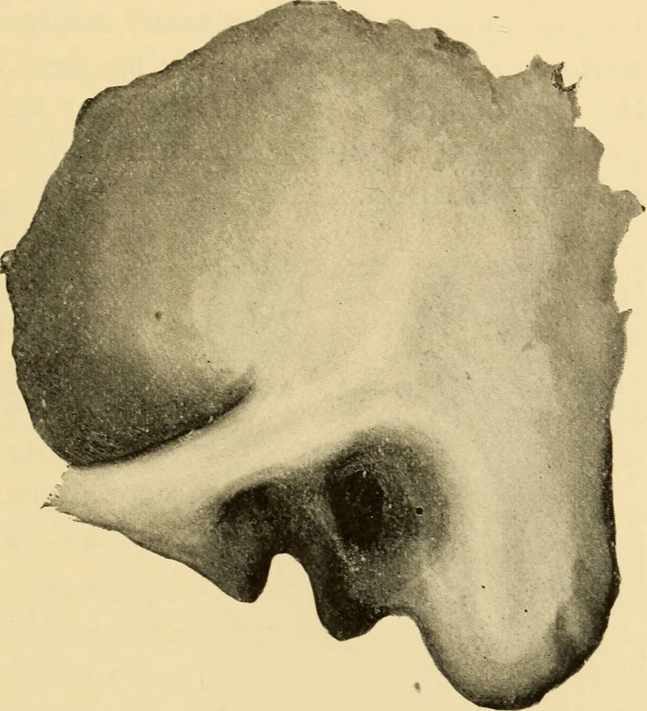 An illustration from Diseases of the ear : a text-book for practitioners and students of medicine / by Edward Bradford Dench., 1900, leaf 483