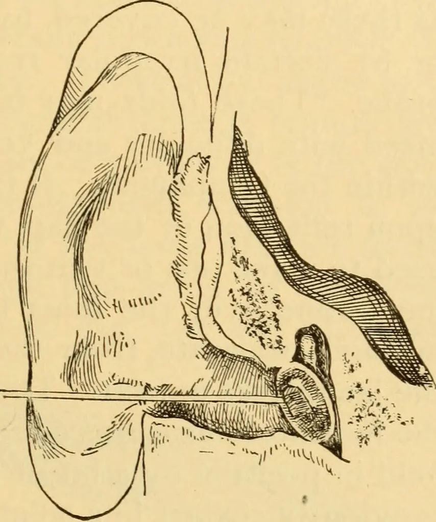 An illustration from Diseases of the ear : a text-book for practitioners and students of medicine / by Edward Bradford Dench., 1900, leaf 519
