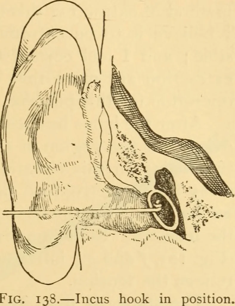 An illustration from Diseases of the ear : a text-book for practitioners and students of medicine / by Edward Bradford Dench., 1900, leaf 537
