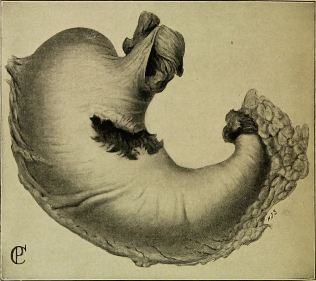 An illustration from Diseases of infants and children / by Henry Dwight Chapin and Godfrey Roger Pisek ; with 181 ill. and eleven colored plates., 1911, leaf 244