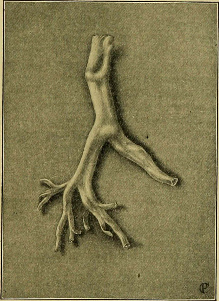 An illustration from Diseases of infants and children / by Henry Dwight Chapin and Godfrey Roger Pisek ; with 181 ill. and eleven colored plates., 1911, leaf 323
