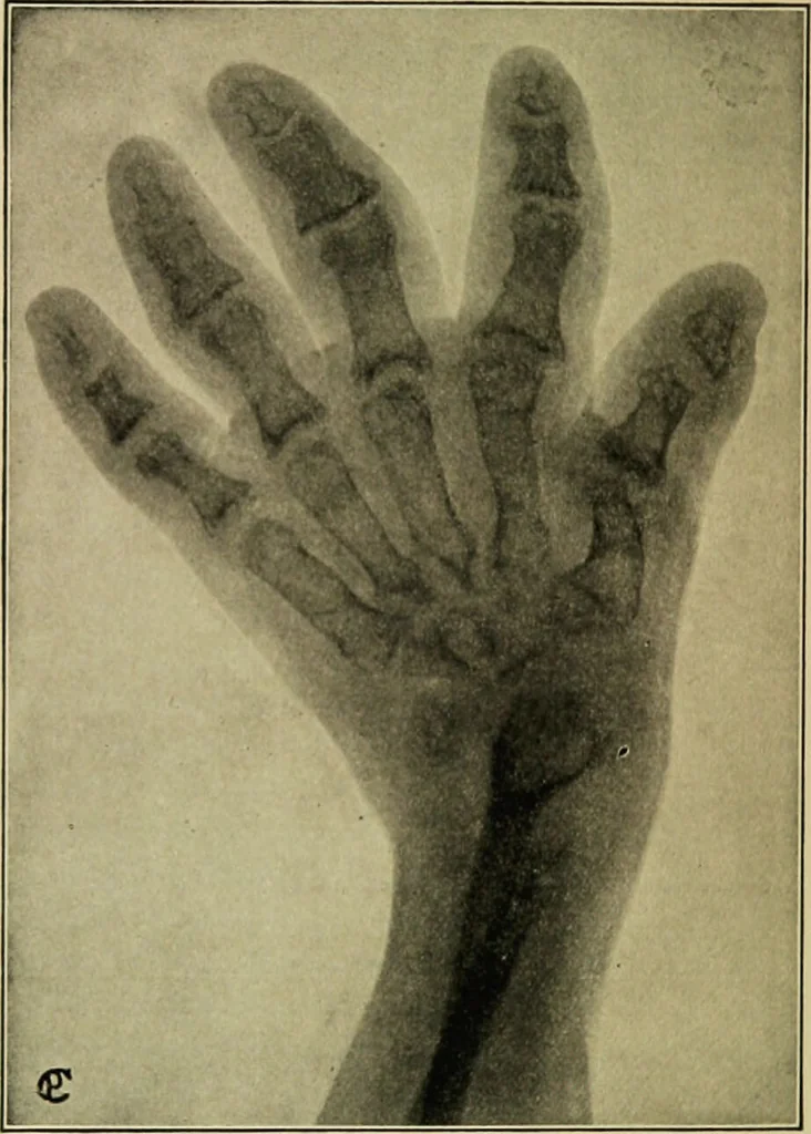 An illustration from Diseases of infants and children / by Henry Dwight Chapin and Godfrey Roger Pisek ; with 181 ill. and eleven colored plates., 1911, leaf 496