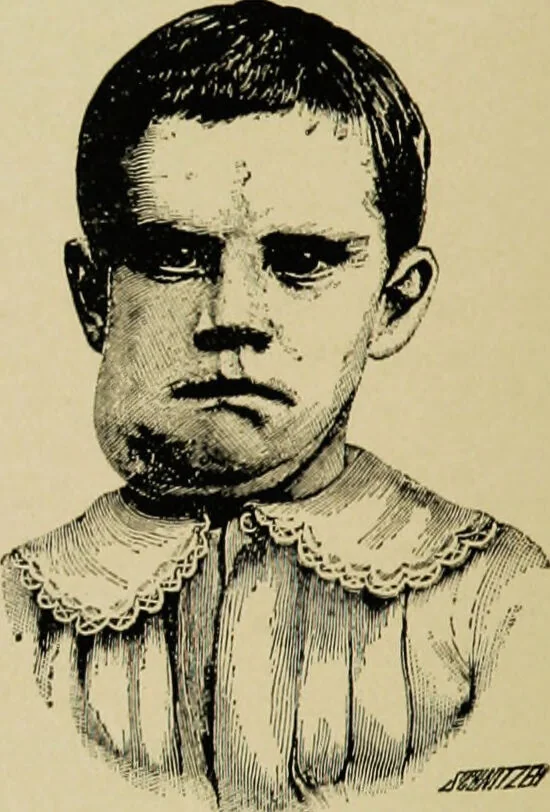An illustration from Diseases of infants and children / by Henry Dwight Chapin and Godfrey Roger Pisek ; with 181 ill. and eleven colored plates., 1911, leaf 608