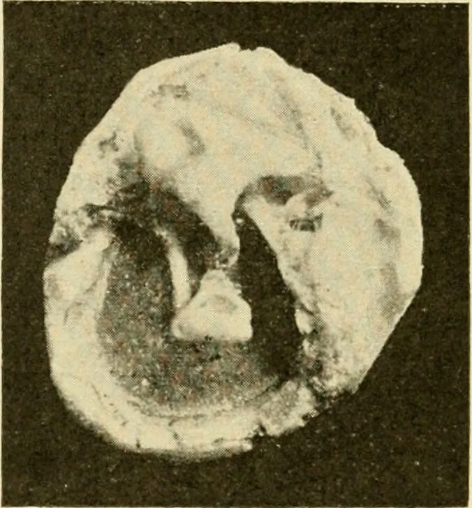 An illustration from A manual of otology / By Gorham Bacon ... With an introductory chapter by Clarence John Blake ... With 110 illustrations and a colored plate., 1898, leaf 196