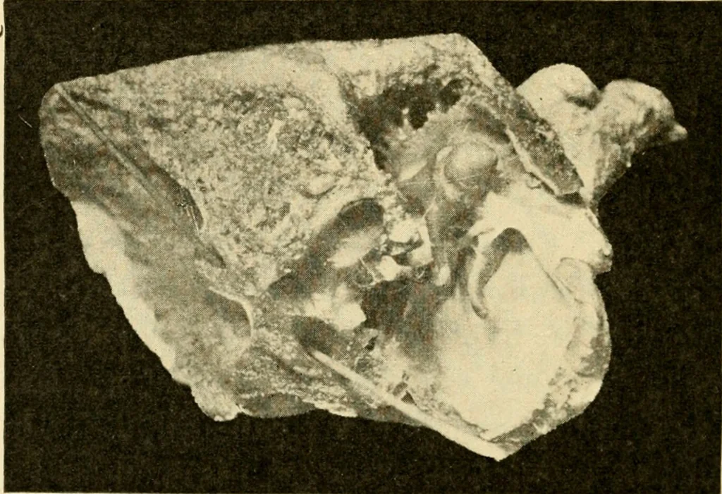 An illustration from A manual of otology / By Gorham Bacon ... With an introductory chapter by Clarence John Blake ... With 110 illustrations and a colored plate., 1898, leaf 200