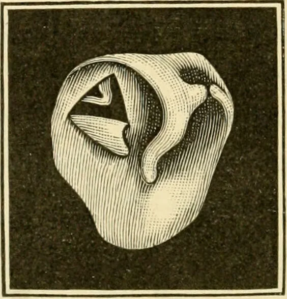 An illustration from A manual of otology / By Gorham Bacon ... With an introductory chapter by Clarence John Blake ... With 110 illustrations and a colored plate., 1898, leaf 224