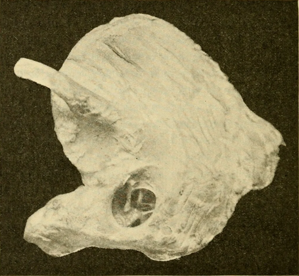 An illustration from A manual of otology / By Gorham Bacon ... With an introductory chapter by Clarence John Blake ... With 110 illustrations and a colored plate., 1898, leaf 314