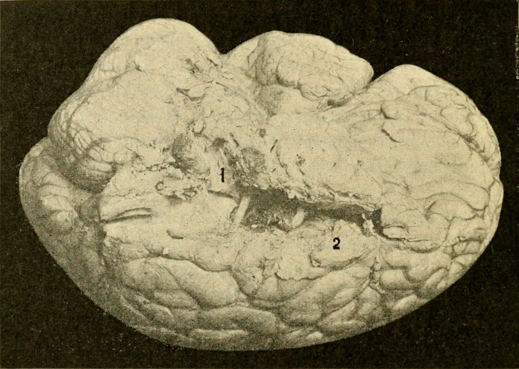 An illustration from A manual of otology / By Gorham Bacon ... With an introductory chapter by Clarence John Blake ... With 110 illustrations and a colored plate., 1898, leaf 326