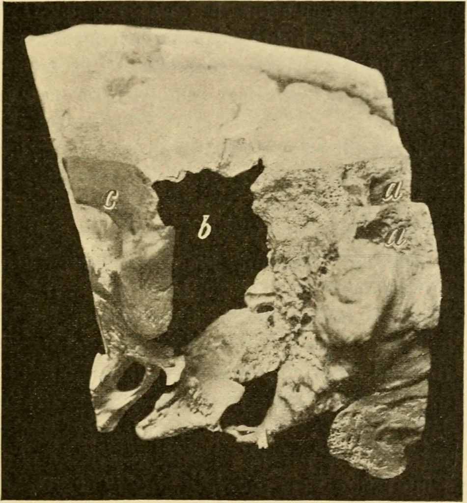 An illustration from A manual of otology / By Gorham Bacon ... With an introductory chapter by Clarence John Blake ... With 110 illustrations and a colored plate., 1898, leaf 335