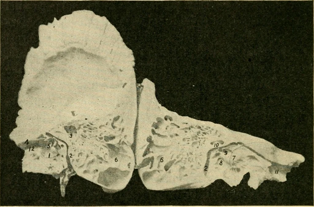 An illustration from A manual of otology / By Gorham Bacon ... With an introductory chapter by Clarence John Blake ... With 110 illustrations and a colored plate., 1898, leaf 44