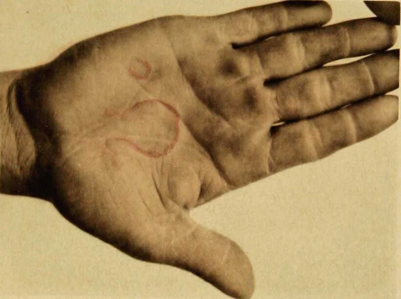 An illustration from Photographic illustrations of skin diseases : Forty-eight plates from life. Colored by hand / by George Henry Fox., 1880, leaf 184