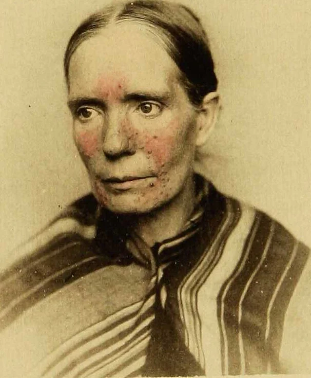 An illustration from Photographic illustrations of skin diseases : Forty-eight plates from life. Colored by hand / by George Henry Fox., 1880, leaf 36