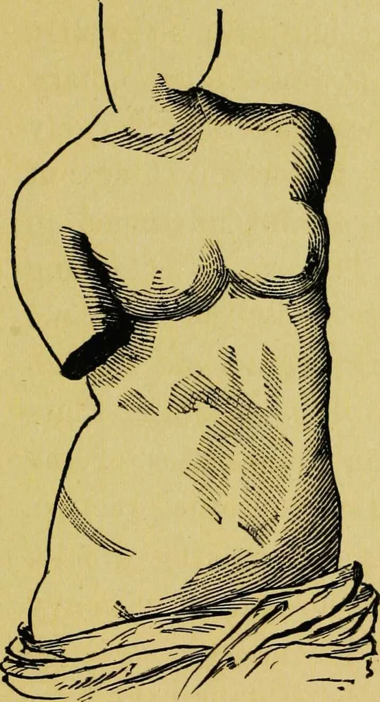 An illustration from Ladies' guide in health and disease : girlhood, maidenhood, wifehood, motherhood / by J.H. Kellogg., 1892, leaf 284