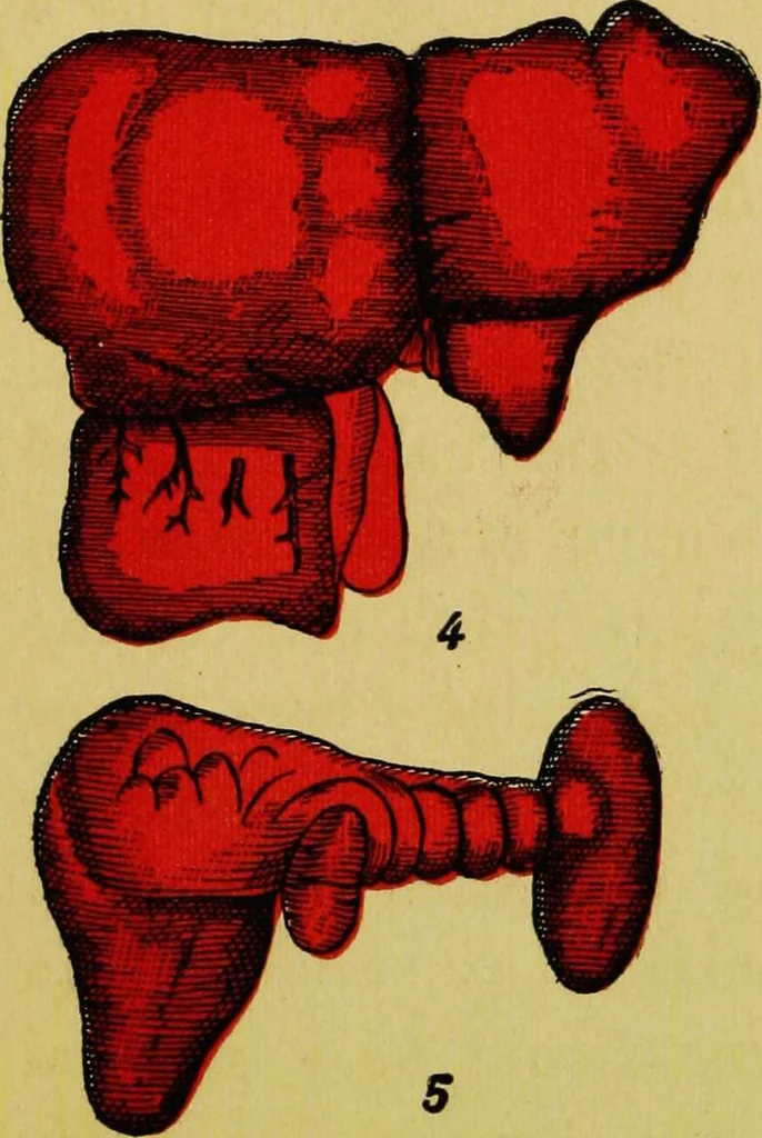 An illustration from Ladies' guide in health and disease : girlhood, maidenhood, wifehood, motherhood / by J.H. Kellogg., 1892, leaf 284