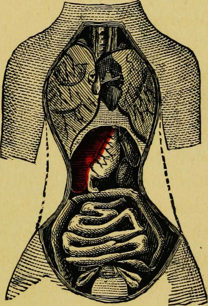 An illustration from Ladies' guide in health and disease : girlhood, maidenhood, wifehood, motherhood / by J.H. Kellogg., 1892, leaf 284