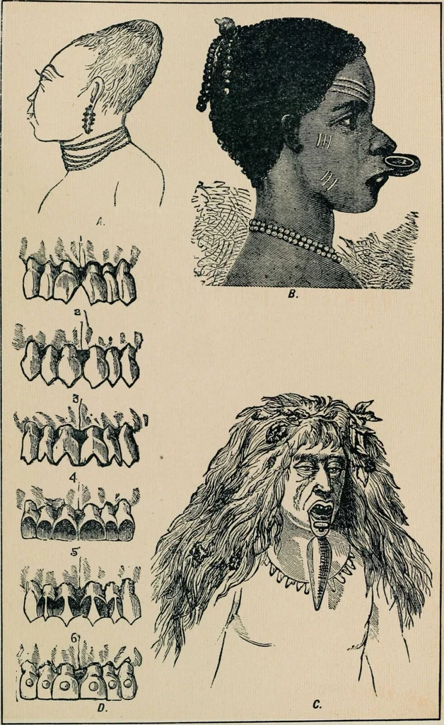 An illustration from Ladies' guide in health and disease : girlhood, maidenhood, wifehood, motherhood / by J.H. Kellogg., 1892, leaf 300