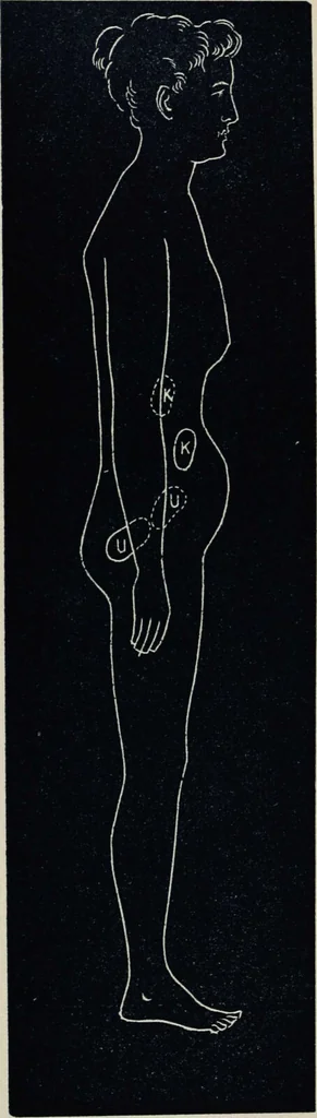 An illustration from Ladies' guide in health and disease : girlhood, maidenhood, wifehood, motherhood / by J.H. Kellogg., 1892, leaf 312