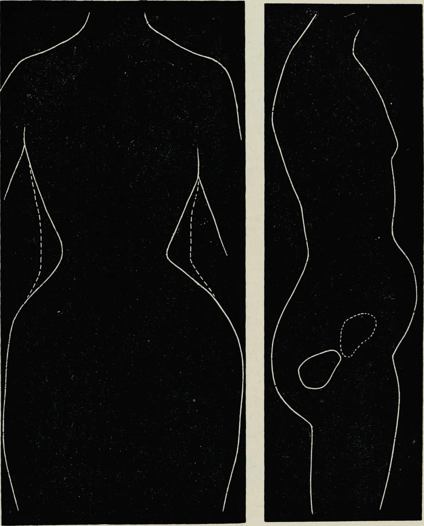 An illustration from Ladies' guide in health and disease : girlhood, maidenhood, wifehood, motherhood / by J.H. Kellogg., 1892, leaf 318
