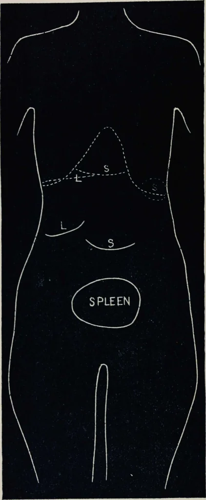 An illustration from Ladies' guide in health and disease : girlhood, maidenhood, wifehood, motherhood / by J.H. Kellogg., 1892, leaf 319